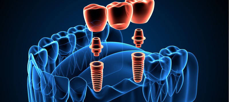 How Do Abutments Attach to Dental Implants?