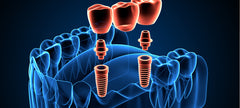 How Do Abutments Attach to Dental Implants?
