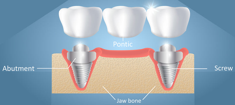 Considering Abutment Selection in Dental Implant Restorations